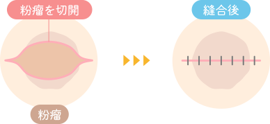 切開法