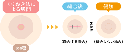 くりぬき法