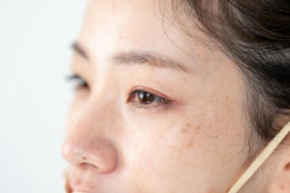 しみ・老人性色素斑・肝斑とは